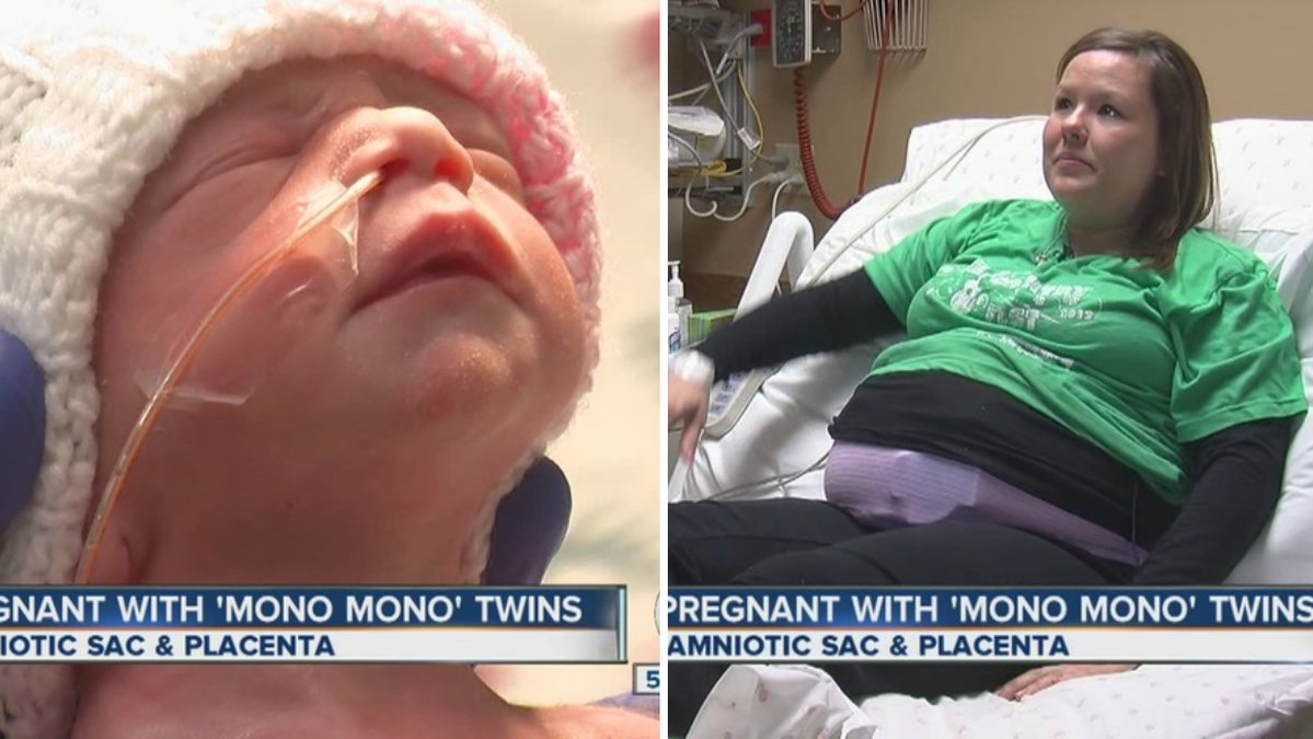 Sarah Thistlewaite födde mono-mono tvillingar. 
